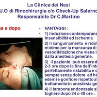 Rinoplastica: tecnica ibrida in anestesia locale