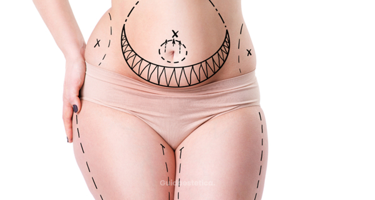 Liposcultura oggi, domani, sempre...si può anche correggere?