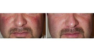 Il trattamento dei capillari del viso