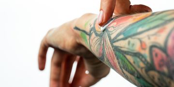 La rimozione dei tatuaggi