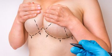 Come prendersi cura delle cicatrici dopo un intervento chirurgico al seno