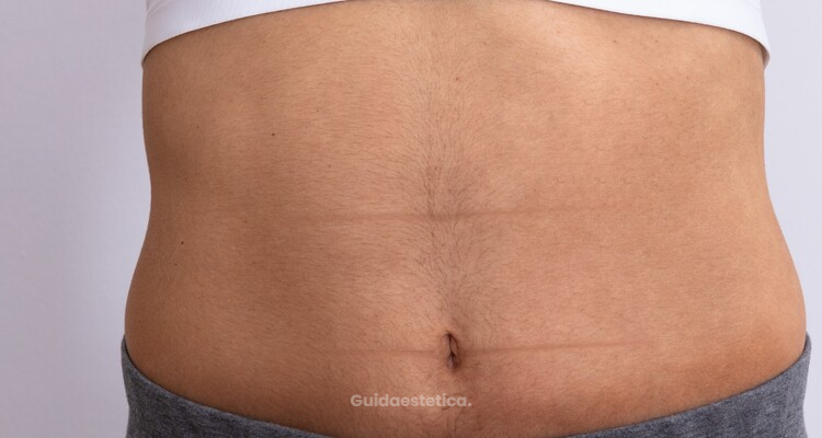 La nuova era della liposuzione: rivoluzionaria tecnologia alternativa al bisturi