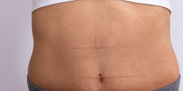 La nuova era della liposuzione: rivoluzionaria tecnologia alternativa al bisturi La nuova era della liposuzione: rivoluzionaria tecnologia alternativa al bisturi