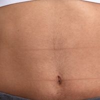 La nuova era della liposuzione: rivoluzionaria tecnologia alternativa al bisturi