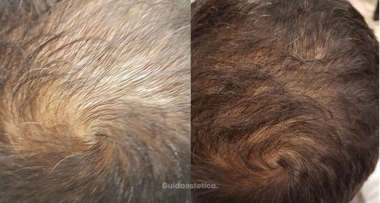 Mesoterapia Tricologica per stimolare la ricrescita dei capelli