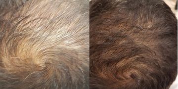 Mesoterapia Tricologica per stimolare la ricrescita dei capelli