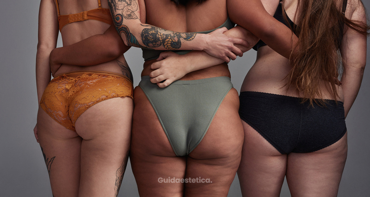 La cellulite, una condizione estetica comune e spesso frustrante