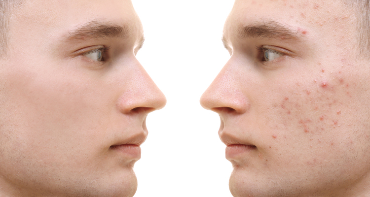 Cicatrici post acne, un altro modo di rigenerazione cutanea