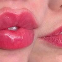 Russian lips la nuova tecnica filler labbra su misura