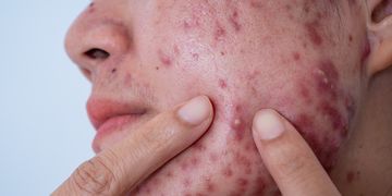 Acne: oltre l'estetica, impatto sulla vita e nuove armi per combatterla