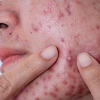 Acne: oltre l'estetica, impatto sulla vita e nuove armi per combatterla