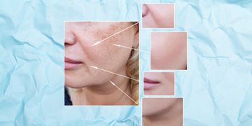 Come eliminare le rughe del viso: soluzioni efficaci e non invasive