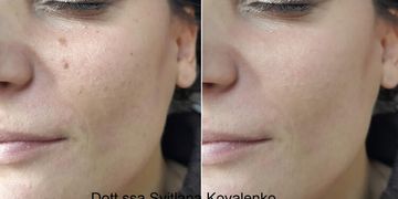 Quali differenze tra i vari filler? Quale filler scegliere?