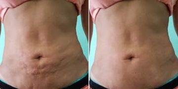 Elimina il grasso ostinato: trattamenti minimamente invasivi per un corpo definito