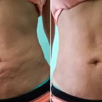 Elimina il grasso ostinato: trattamenti minimamente invasivi per un corpo definito