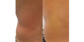 5 miti da sfatare sulla lipoterapia: verità, emozioni e risultati per il tuo corpo