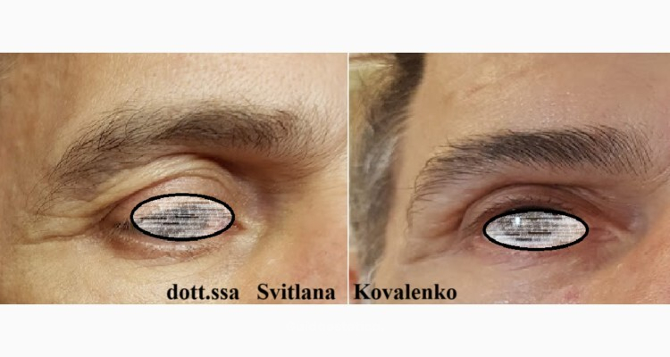 Palpebre cadenti? Ringiovanisci lo sguardo con trattamenti non invasivi per uomini e donne
