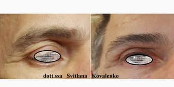 Palpebre cadenti? Ringiovanisci lo sguardo con trattamenti non invasivi per uomini e donne