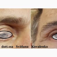 Palpebre cadenti? Ringiovanisci lo sguardo con trattamenti non invasivi per uomini e donne