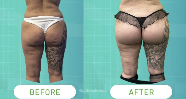 Gluteoplastica con tecnica Sub-Muscular SAFE: la nuova frontiera del rimodellamento glutei