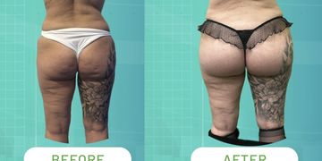 Gluteoplastica con tecnica Sub-Muscular SAFE: la nuova frontiera del rimodellamento glutei Gluteoplastica con tecnica Sub-Muscular SAFE: la nuova frontiera del rimodellamento glutei