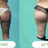 Gluteoplastica con tecnica Sub-Muscular SAFE: la nuova frontiera del rimodellamento glutei