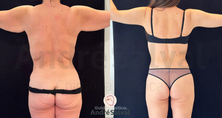 Chirurgia post-bariatrica: completare la trasformazione del corpo e della vita