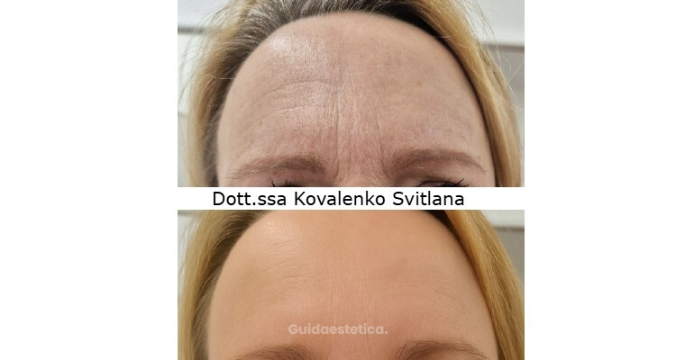 Tossina botulinica fronte: la verità che ogni donna dovrebbe conoscere