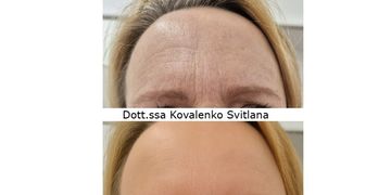 Tossina botulinica fronte: la verità che ogni donna dovrebbe conoscere