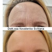 Tossina botulinica fronte: la verità che ogni donna dovrebbe conoscere