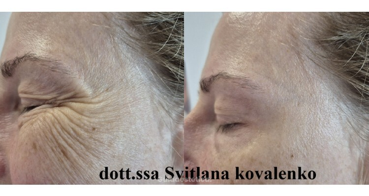 La tossina botulinica liquida: miracolo moderno o solo scienza? Benvenuti nel mondo del botox