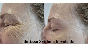 La tossina botulinica liquida: miracolo moderno o solo scienza? Benvenuti nel mondo del botox