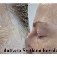 La tossina botulinica liquida: miracolo moderno o solo scienza? Benvenuti nel mondo del botox