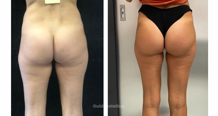 Dormire, curarsi e tornare alle attività senza ansie: la guida completa al post-operatorio della gluteoplastica