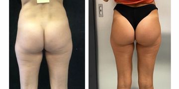 Dormire, curarsi e tornare alle attività senza ansie: la guida completa al post-operatorio della gluteoplastica Dormire, curarsi e tornare alle attività senza ansie: la guida completa al post-operatorio della gluteoplastica