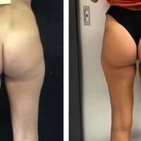 Dormire, curarsi e tornare alle attività senza ansie: la guida completa al post-operatorio della gluteoplastica