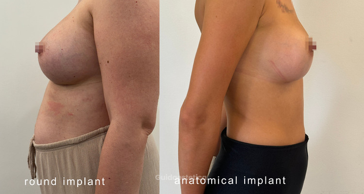 Protesi anatomiche o rotonde? Le differenze nei risultati e l’importanza di una scelta personalizzata