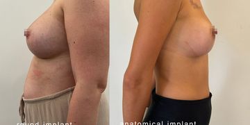 Protesi anatomiche o rotonde? Le differenze nei risultati e l’importanza di una scelta personalizzata