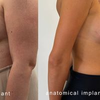 Protesi anatomiche o rotonde? Le differenze nei risultati e l’importanza di una scelta personalizzata
