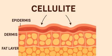 Vasersmooth: la tecnologia mini-invasiva che combatte la cellulite fibrotica e sclerotica Vasersmooth: la tecnologia mini-invasiva che combatte la cellulite fibrotica e sclerotica
