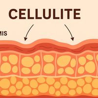 Vasersmooth: la tecnologia mini-invasiva che combatte la cellulite fibrotica e sclerotica