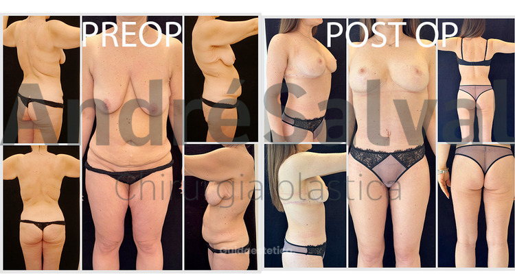 Quando il dimagrimento rapido cambia la forma del corpo