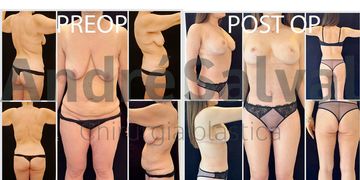 Quando il dimagrimento rapido cambia la forma del corpo Quando il dimagrimento rapido cambia la forma del corpo