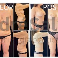 Quando il dimagrimento rapido cambia la forma del corpo Quando il dimagrimento rapido cambia la forma del corpo