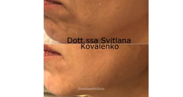 Jawline natural lift con radiesse: come ridefinire la mandibola senza chirurgia