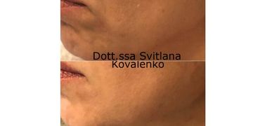 Jawline natural lift con radiesse: come ridefinire la mandibola senza chirurgia