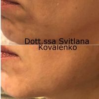 Jawline natural lift con radiesse: come ridefinire la mandibola senza chirurgia