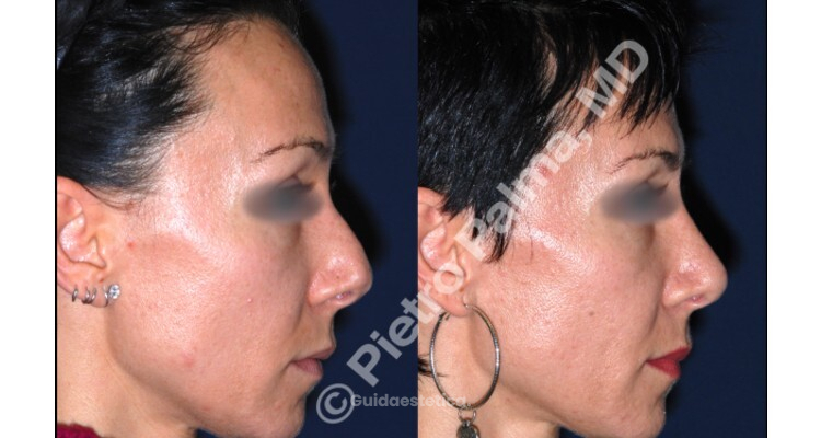 Come cambia il viso dopo una rinoplastica? La vera armonia è quella che non si nota