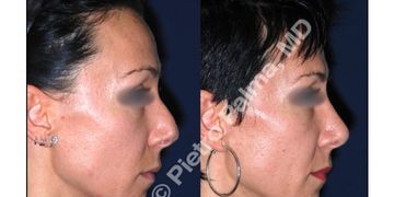 Come cambia il viso dopo una rinoplastica? La vera armonia è quella che non si nota Come cambia il viso dopo una rinoplastica? La vera armonia è quella che non si nota