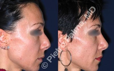 Come cambia il viso dopo una rinoplastica? La vera armonia è quella che non si nota Come cambia il viso dopo una rinoplastica? La vera armonia è quella che non si nota